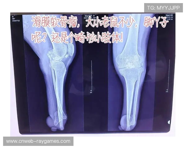 国家德比赛后卡瓦哈尔需接受膝盖手术，关节游离体问题影响职业生涯